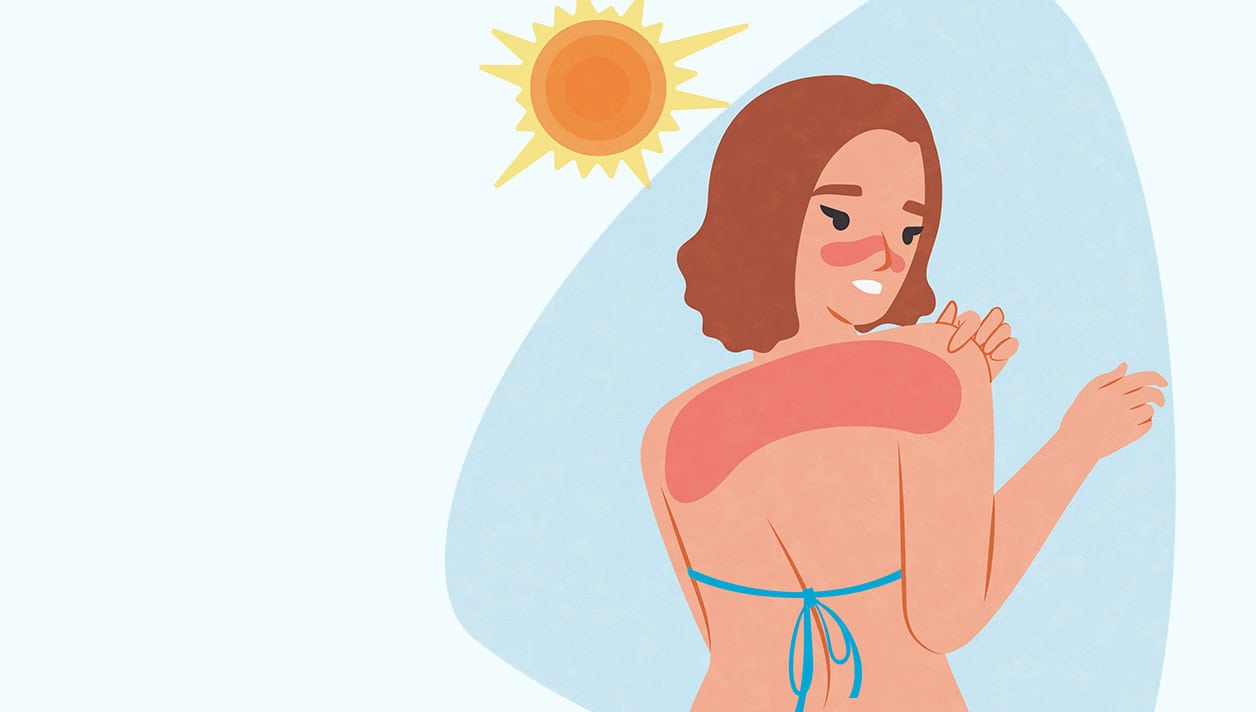 Ilustração de queimadura de sol vs bronzeado